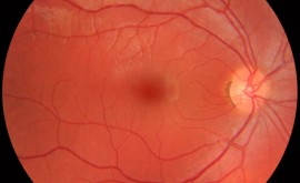 Fundus_photograph of a healthy right eye