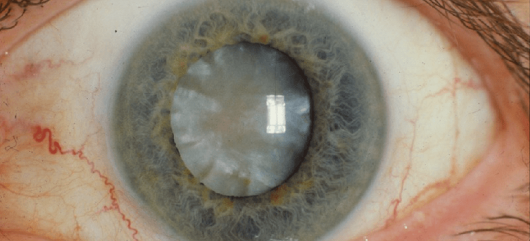 Zoomed in eye with a big cataract
