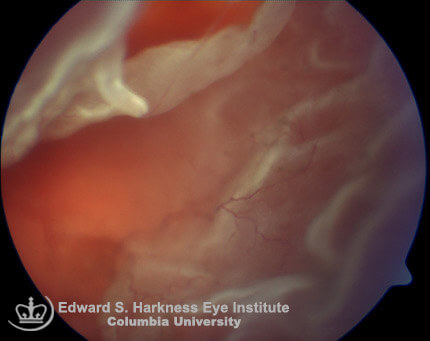 Rhegmatogenous retinal detachment