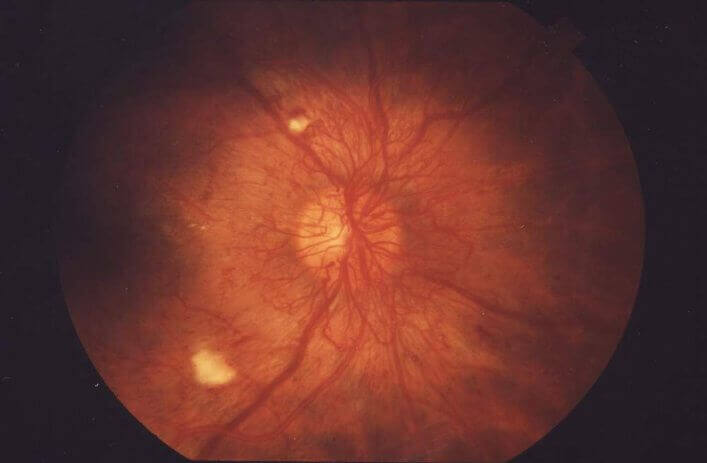 proliferative retinopathy